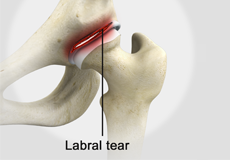 Labral Tears of the Hip